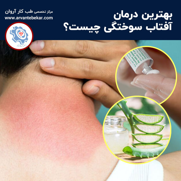 درمان-آفتاب-سوختگی